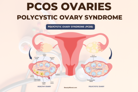 PCOS Ovaries Polycystic Ovary Syndrome