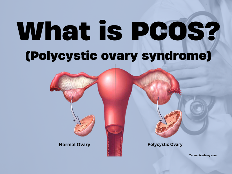 What is PCOS (Polycystic ovary syndrome)